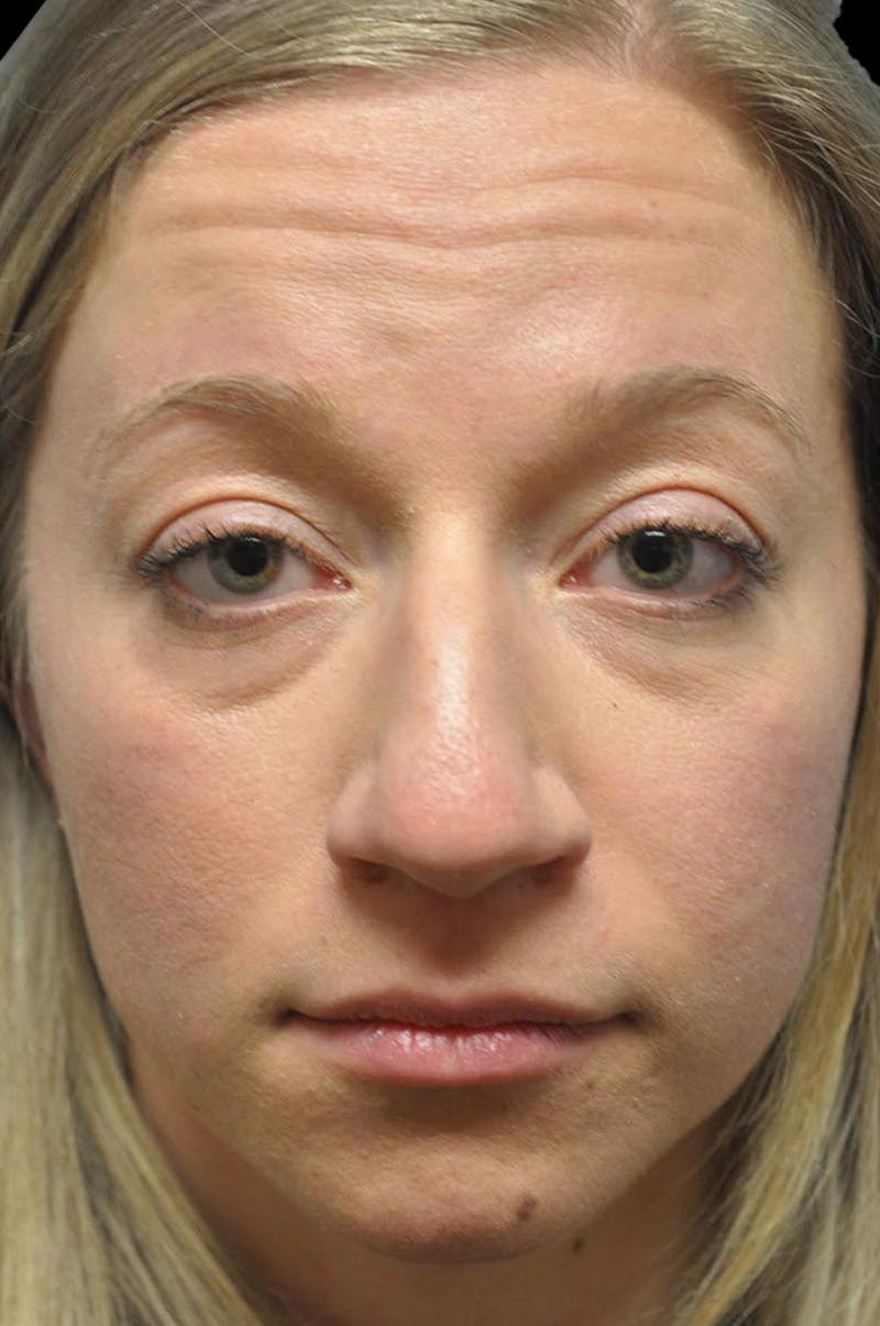 Rhinoplasty Before & After Gallery - Patient 232491 - Image 1