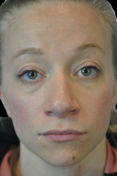 Rhinoplasty Before & After Gallery - Patient 232491 - Image 2