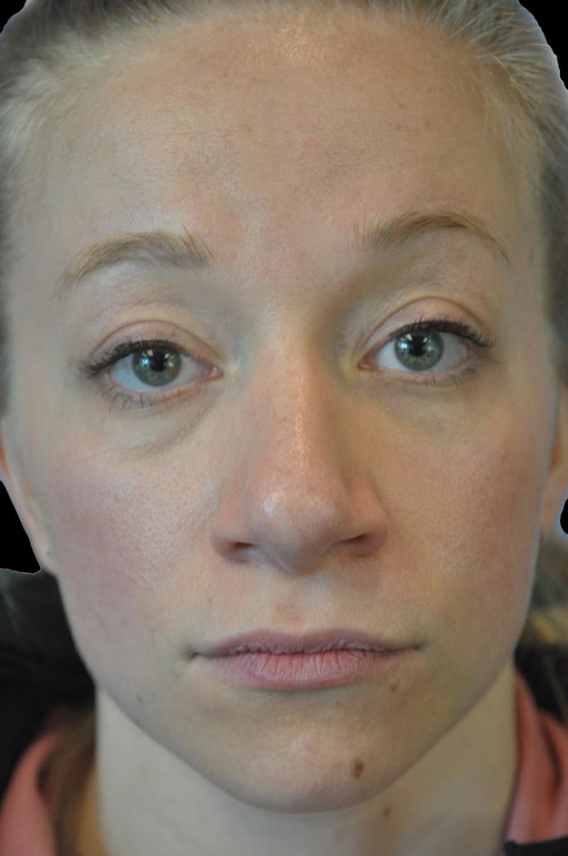 Rhinoplasty Before & After Gallery - Patient 232491 - Image 2