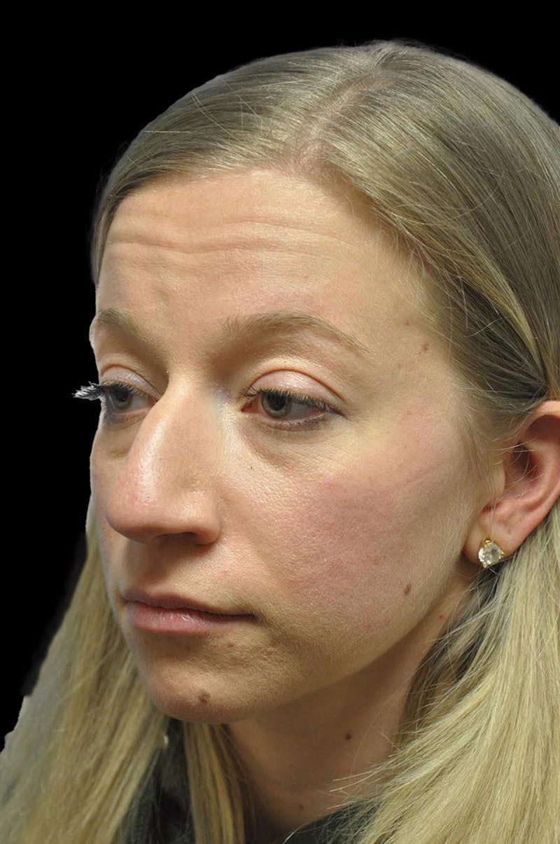Rhinoplasty Before & After Gallery - Patient 232491 - Image 3