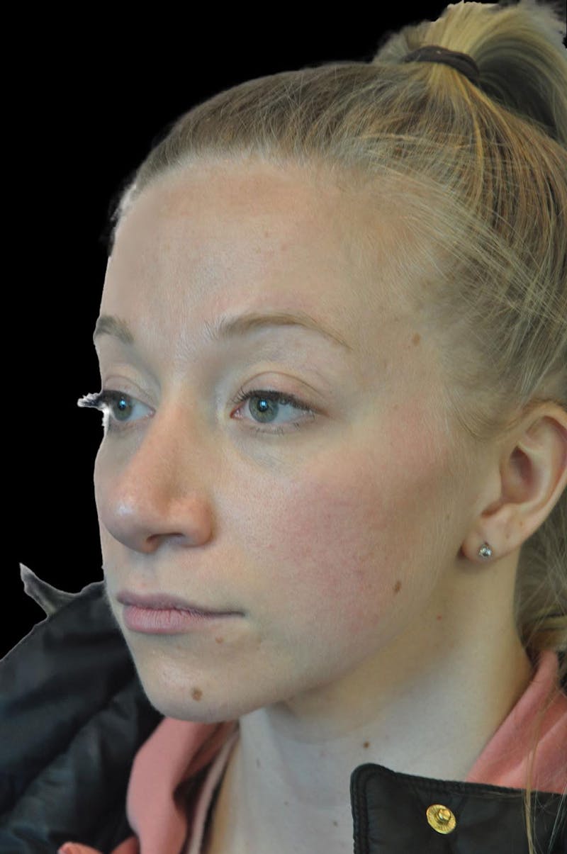 Rhinoplasty Before & After Gallery - Patient 232491 - Image 4
