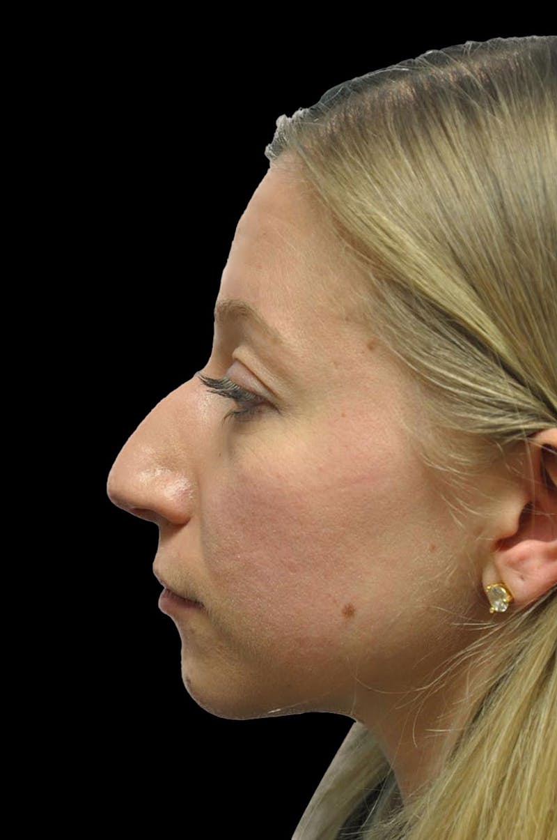 Rhinoplasty Before & After Gallery - Patient 232491 - Image 5