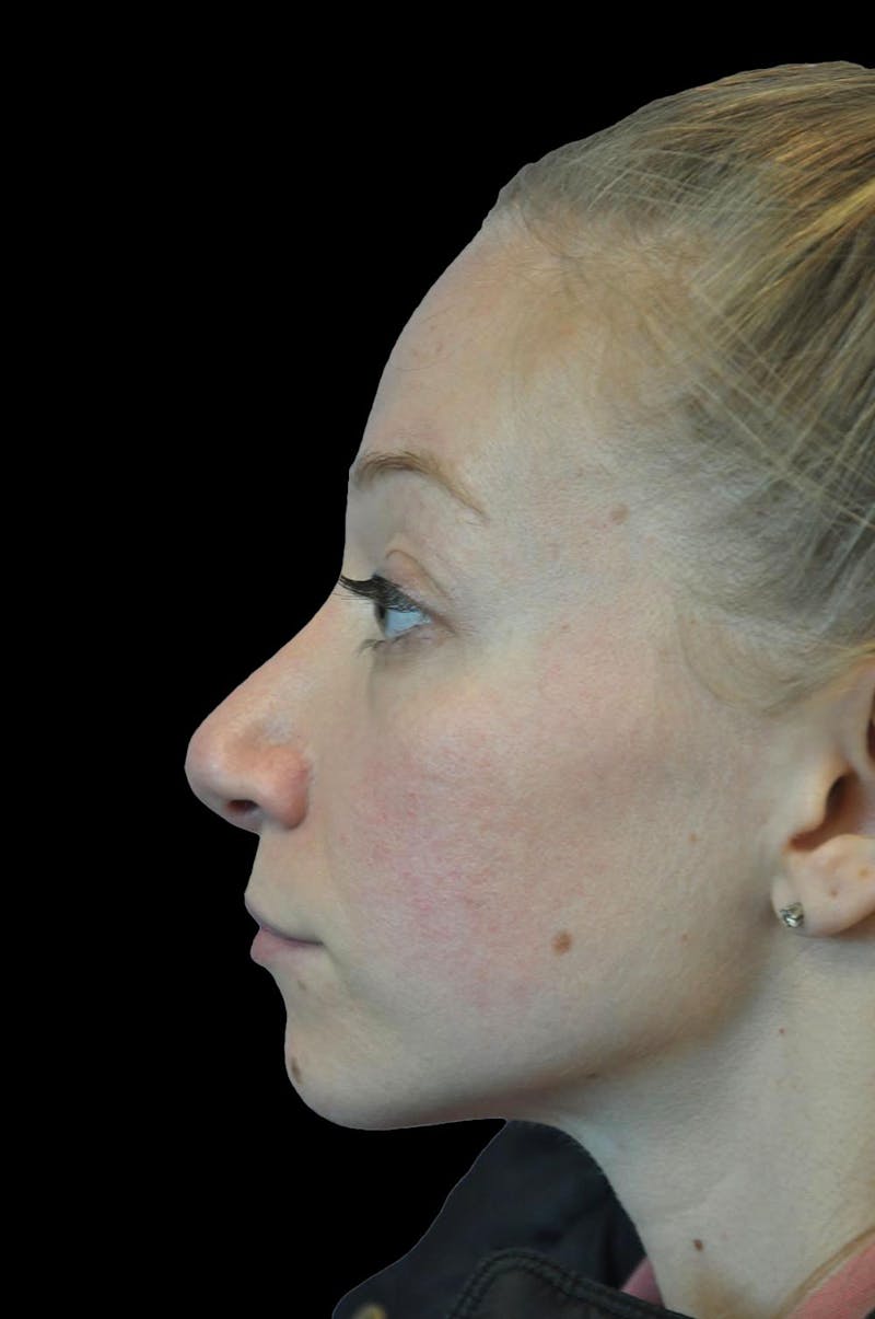 Rhinoplasty Before & After Gallery - Patient 232491 - Image 6