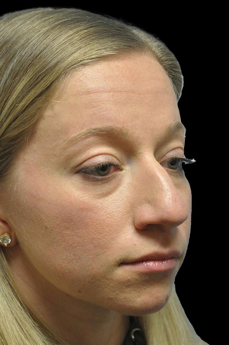 Rhinoplasty Before & After Gallery - Patient 232491 - Image 7