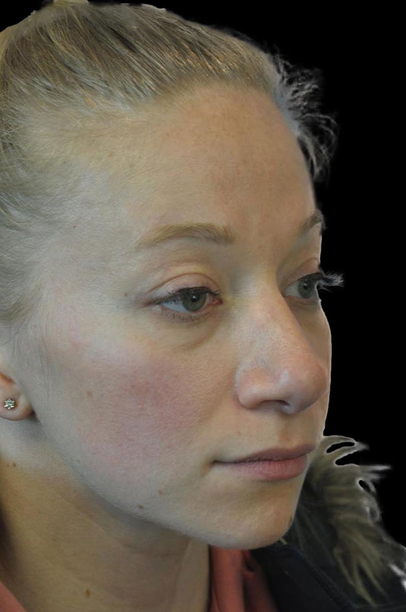 Rhinoplasty Before & After Gallery - Patient 232491 - Image 8