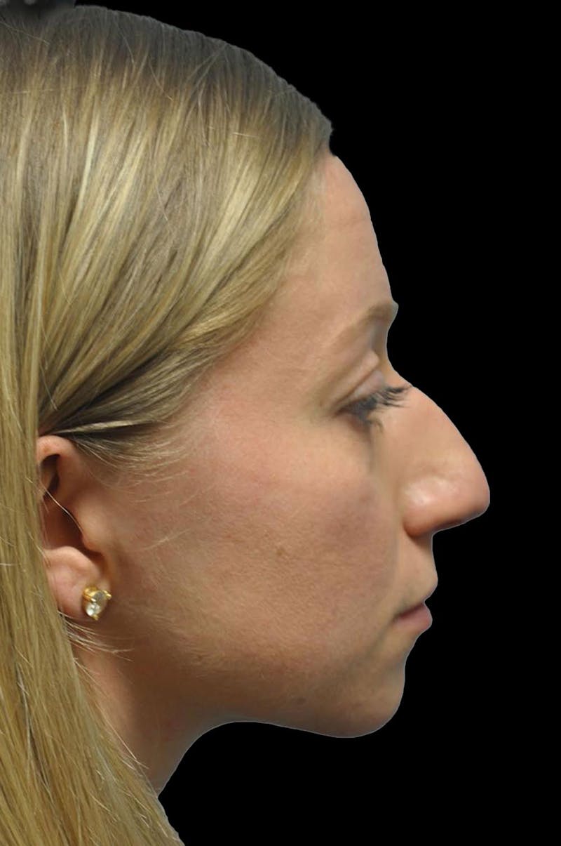 Rhinoplasty Before & After Gallery - Patient 232491 - Image 9