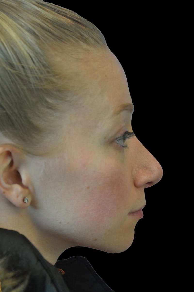 Rhinoplasty Before & After Gallery - Patient 232491 - Image 10