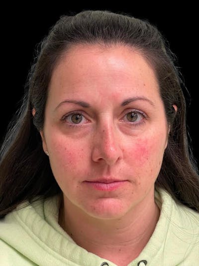 Rhinoplasty Before & After Gallery - Patient 351784 - Image 1