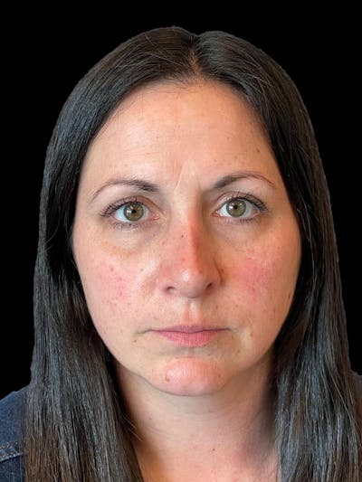 Rhinoplasty Before & After Gallery - Patient 351784 - Image 2