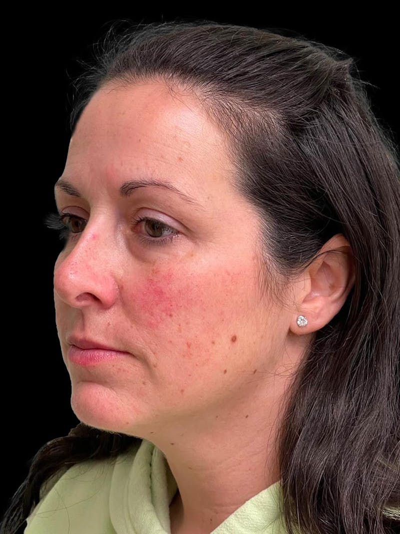 Rhinoplasty Before & After Gallery - Patient 351784 - Image 3