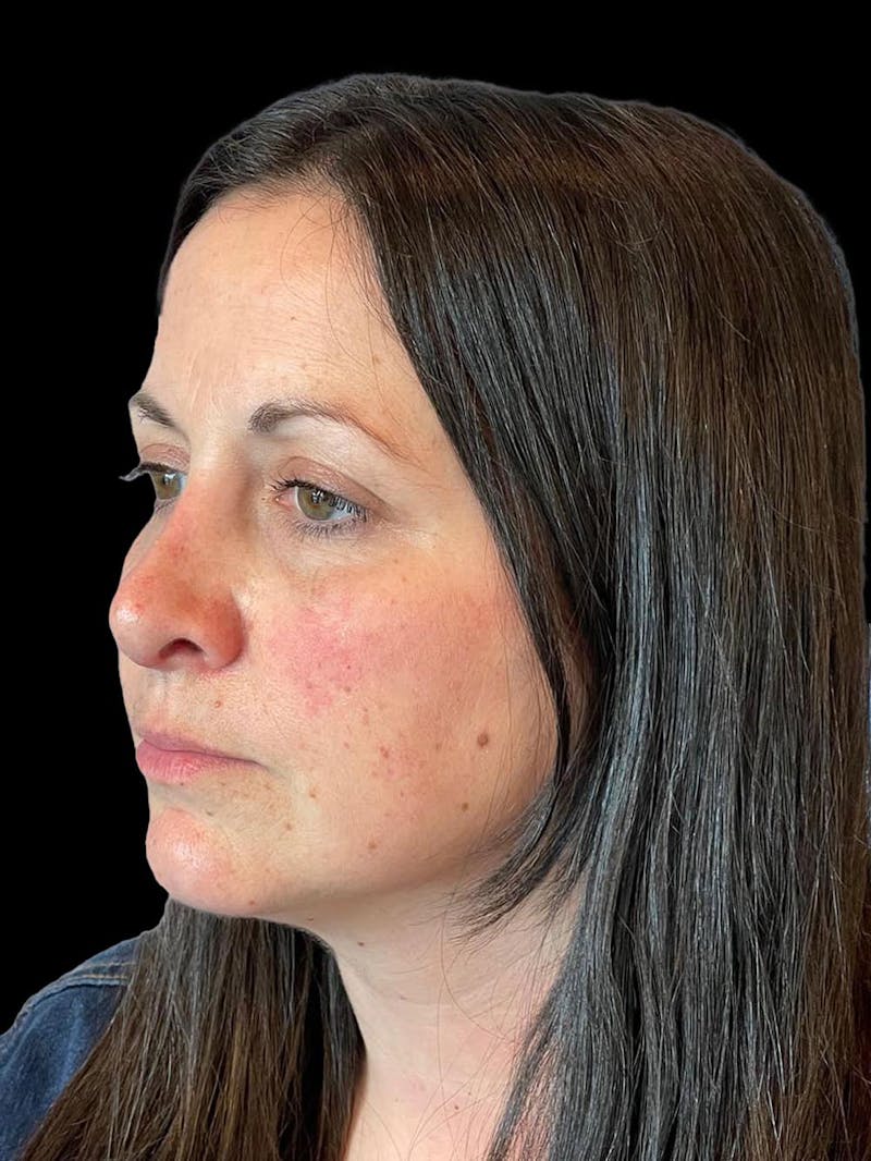 Rhinoplasty Before & After Gallery - Patient 351784 - Image 4