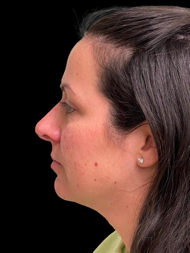 Rhinoplasty Before & After Gallery - Patient 351784 - Image 5