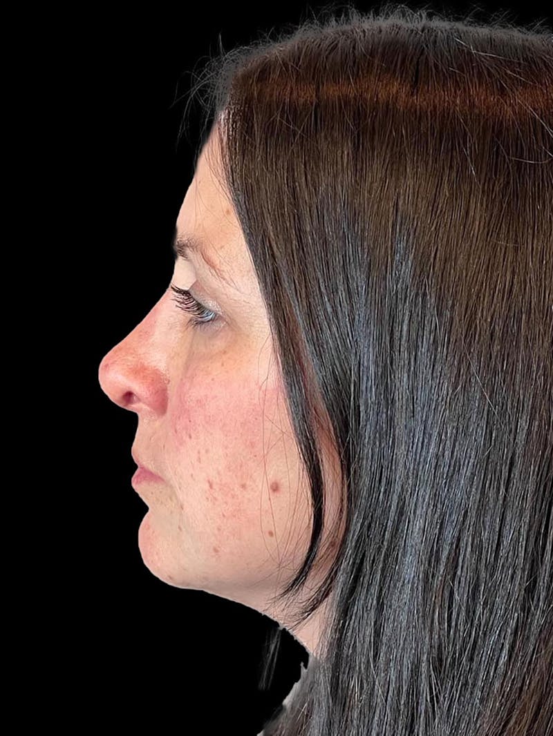 Rhinoplasty Before & After Gallery - Patient 351784 - Image 6
