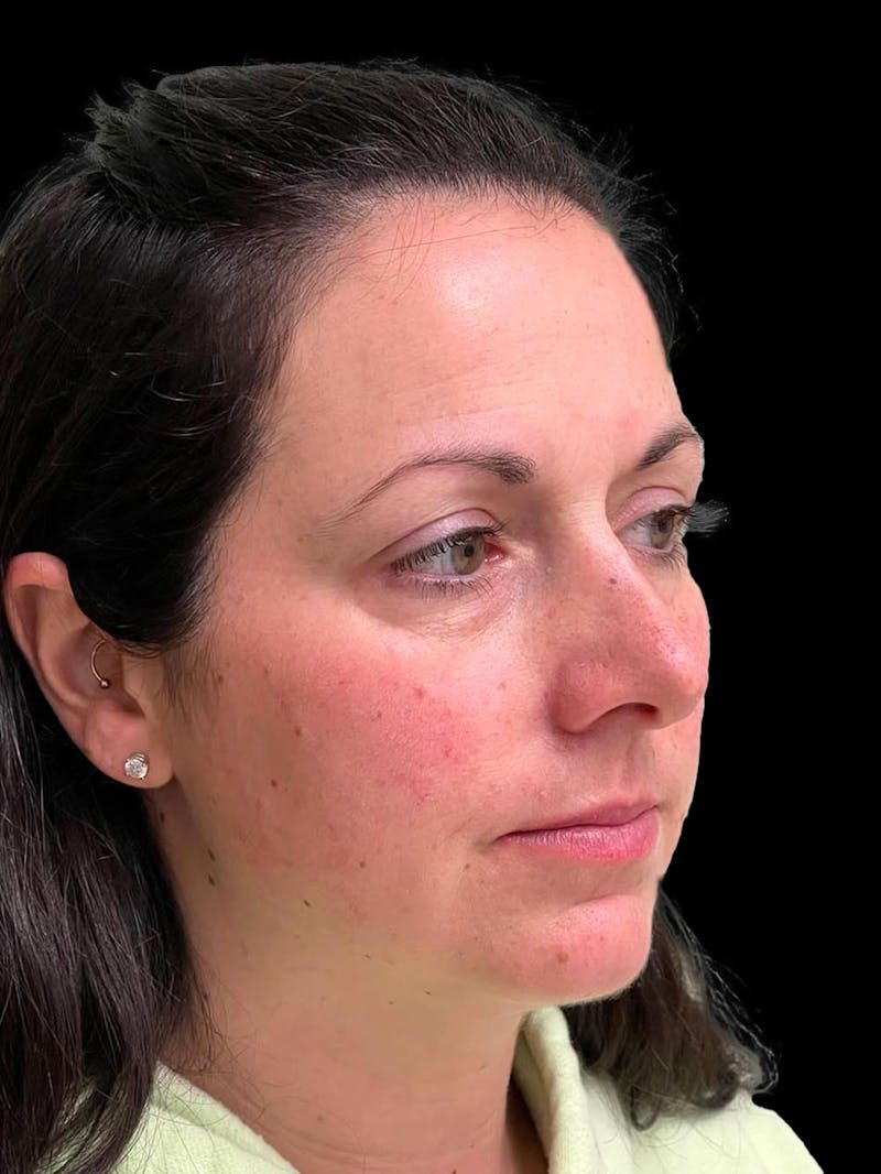 Rhinoplasty Before & After Gallery - Patient 351784 - Image 7
