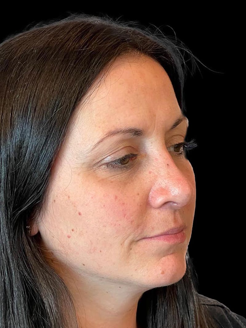 Rhinoplasty Before & After Gallery - Patient 351784 - Image 8