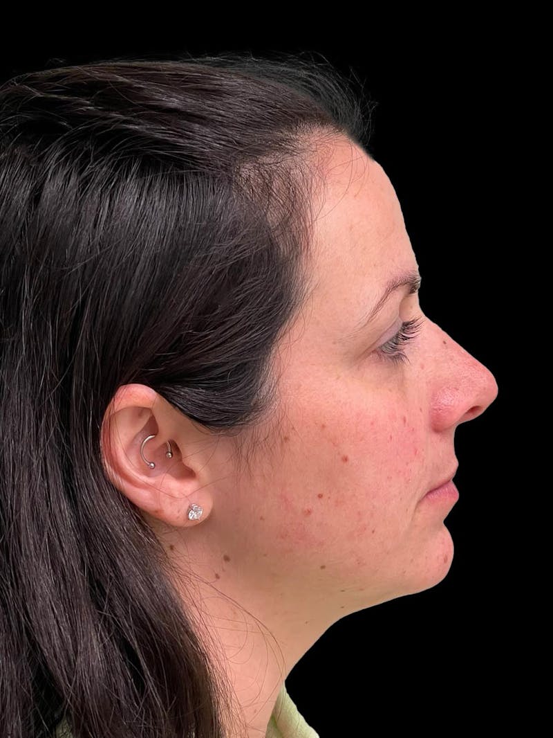 Rhinoplasty Before & After Gallery - Patient 351784 - Image 9