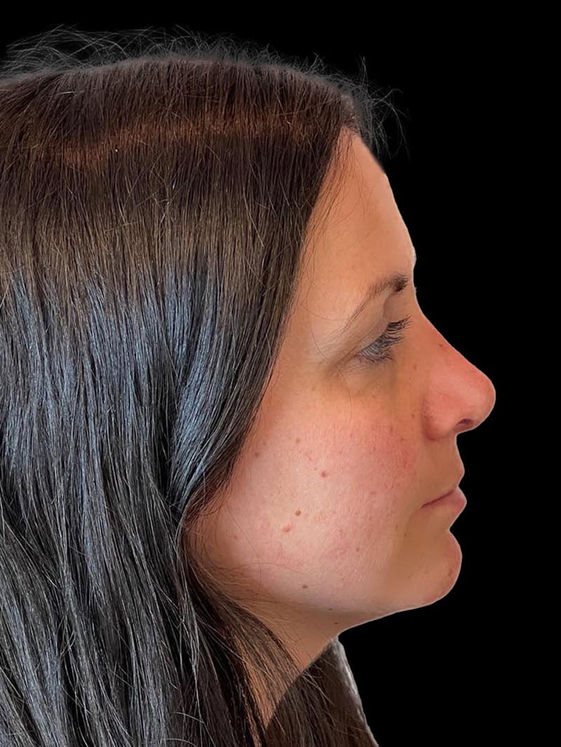 Rhinoplasty Before & After Gallery - Patient 351784 - Image 10