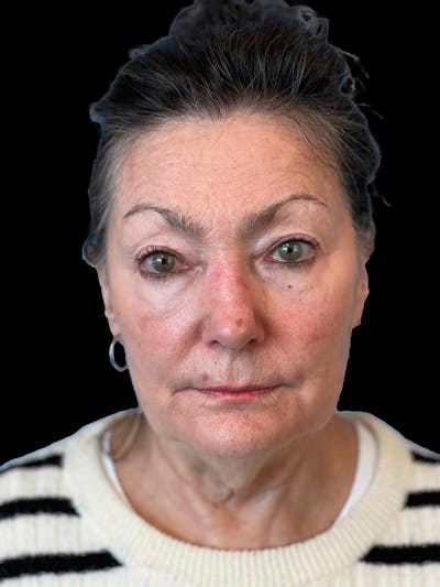 Blepharoplasty Before & After Gallery - Patient 337957 - Image 1