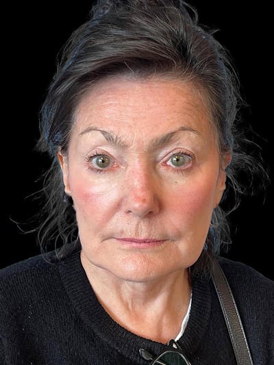 Blepharoplasty Before & After Gallery - Patient 337957 - Image 2