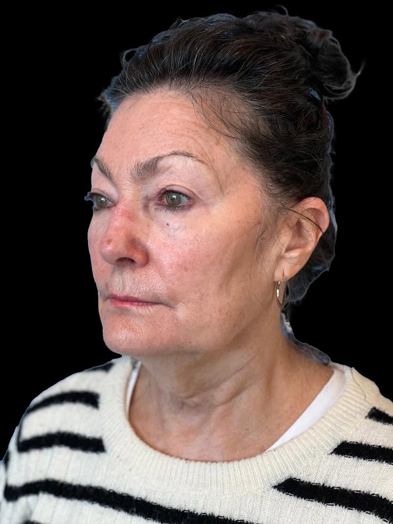 Blepharoplasty Before & After Gallery - Patient 337957 - Image 3