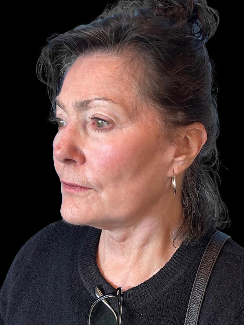 Blepharoplasty Before & After Gallery - Patient 337957 - Image 4