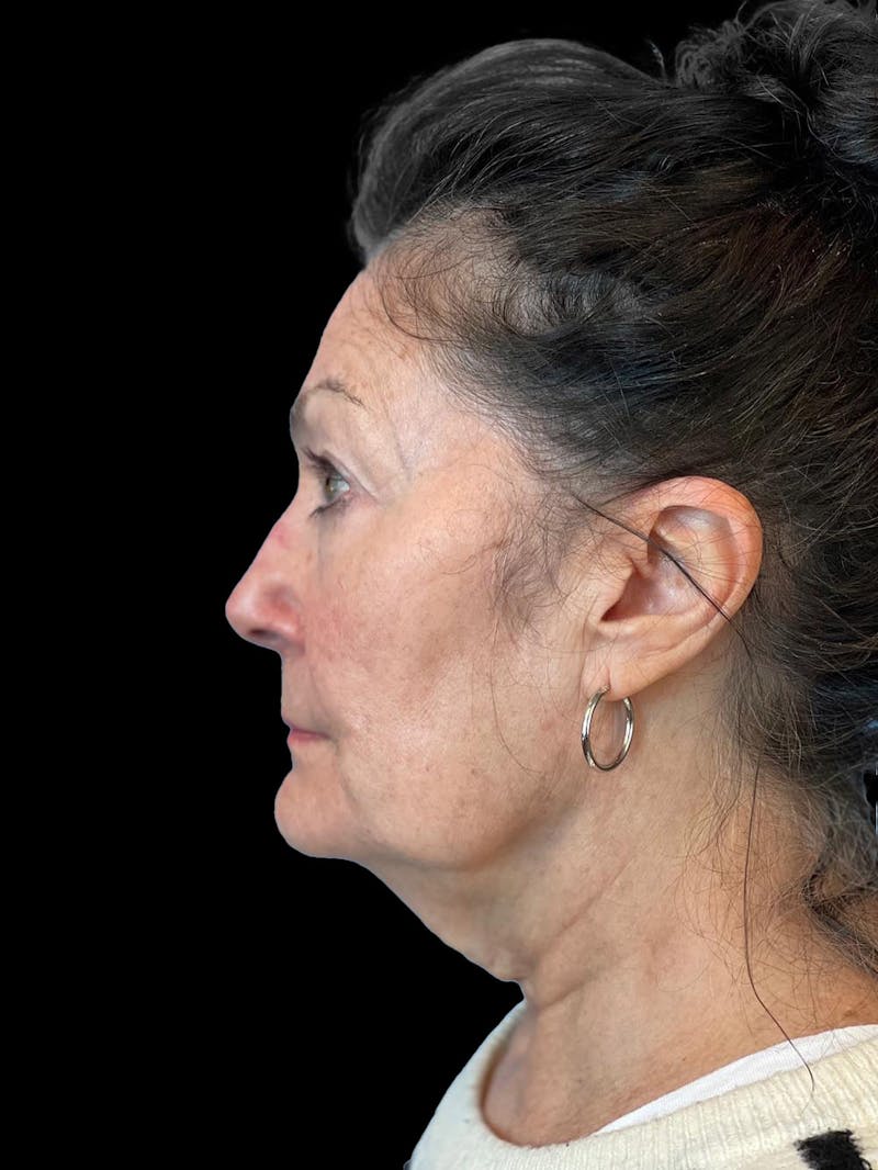 Blepharoplasty Before & After Gallery - Patient 337957 - Image 5