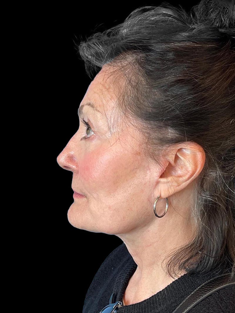 Blepharoplasty Before & After Gallery - Patient 337957 - Image 6