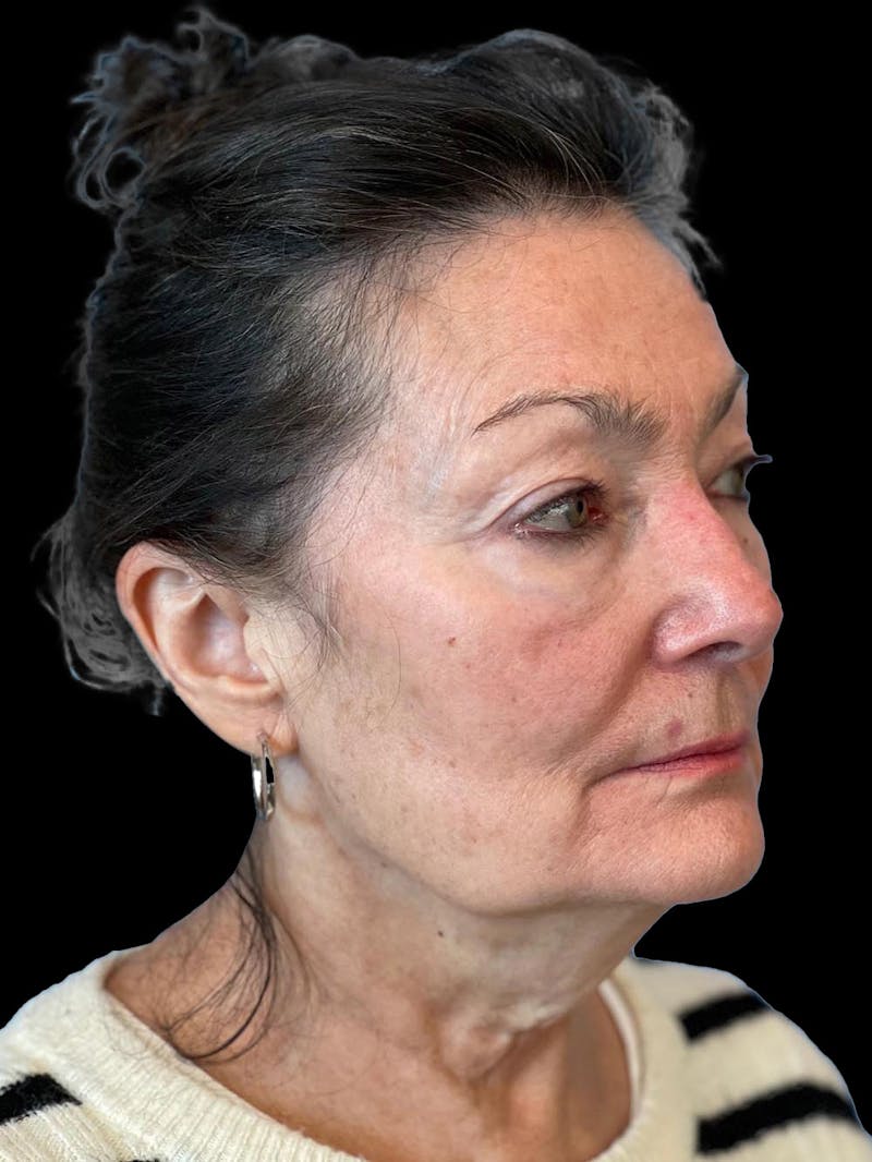 Blepharoplasty Before & After Gallery - Patient 337957 - Image 7