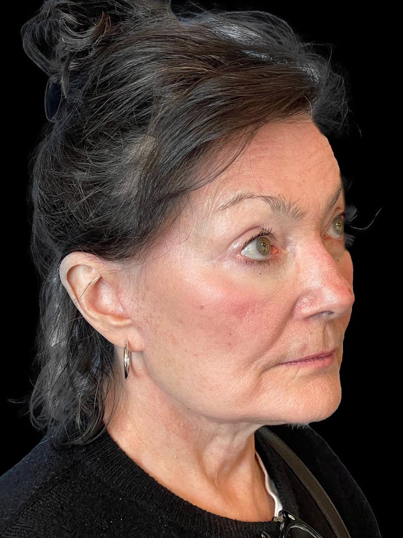Blepharoplasty Before & After Gallery - Patient 337957 - Image 8