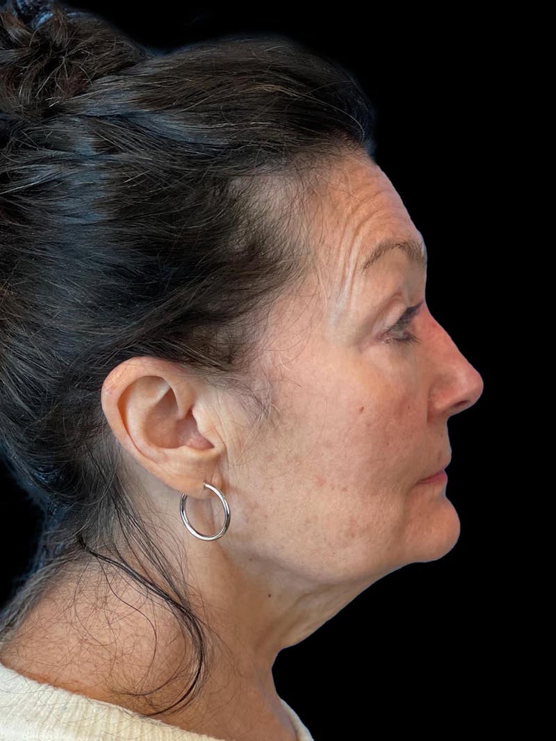 Blepharoplasty Before & After Gallery - Patient 337957 - Image 9