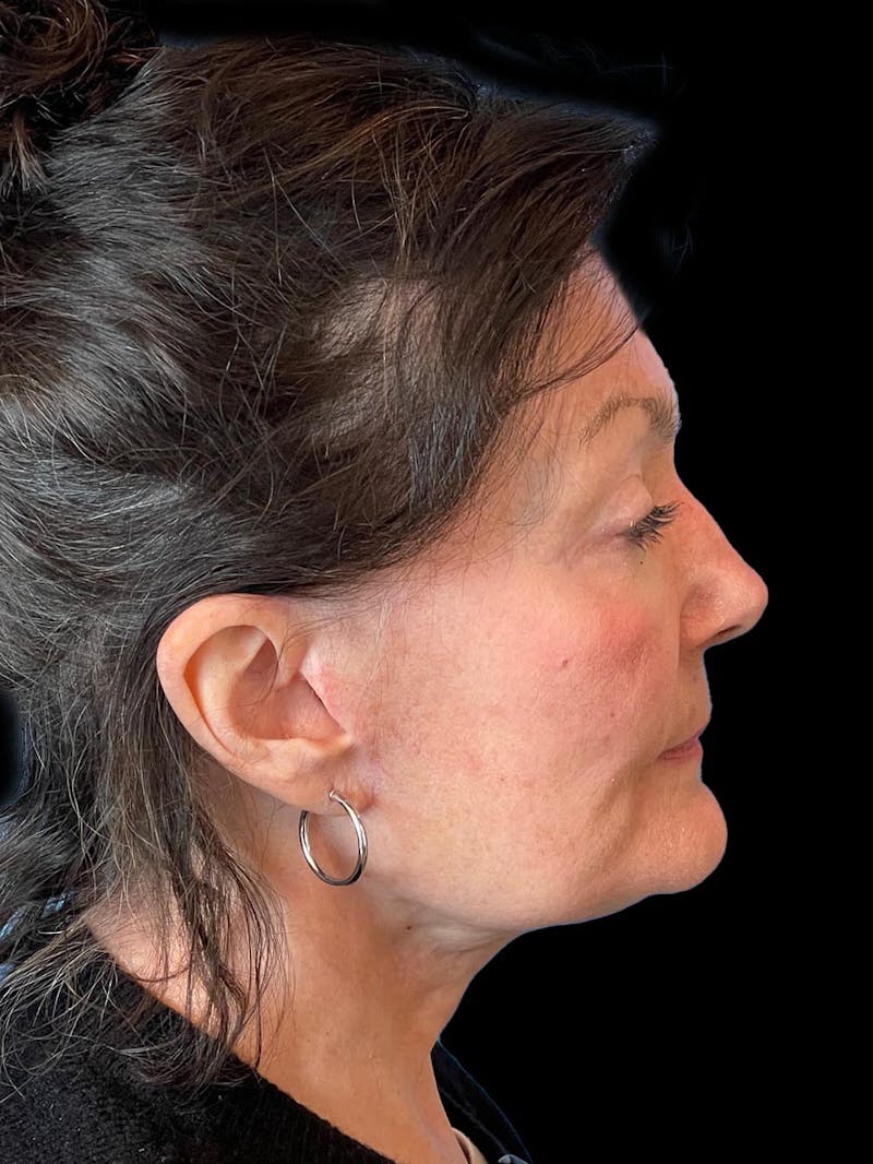 Blepharoplasty Before & After Gallery - Patient 337957 - Image 10