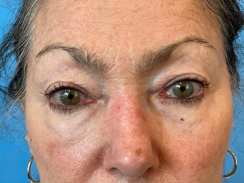 Blepharoplasty Before & After Gallery - Patient 337957 - Image 11