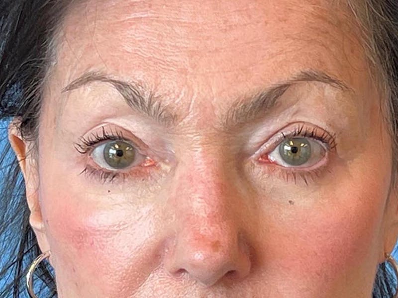 Blepharoplasty Before & After Gallery - Patient 337957 - Image 12