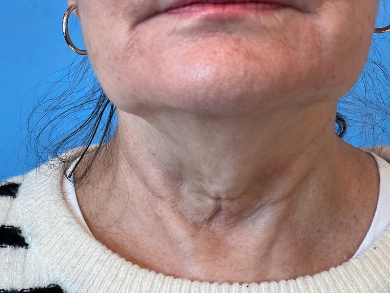 Blepharoplasty Before & After Gallery - Patient 337957 - Image 13