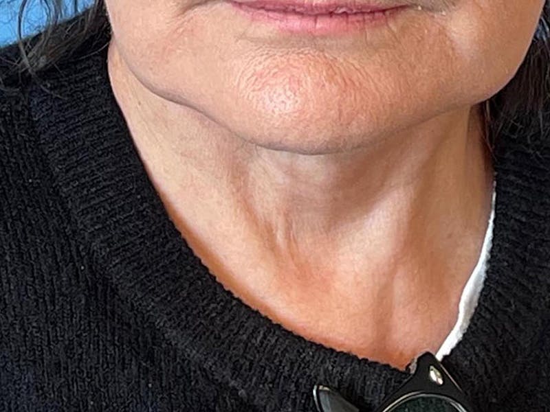 Blepharoplasty Before & After Gallery - Patient 337957 - Image 14