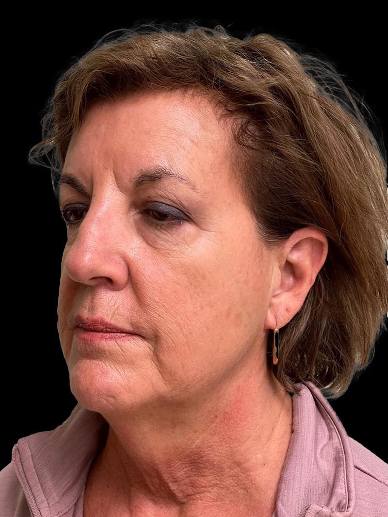 Necklift Before & After Gallery - Patient 552891 - Image 3