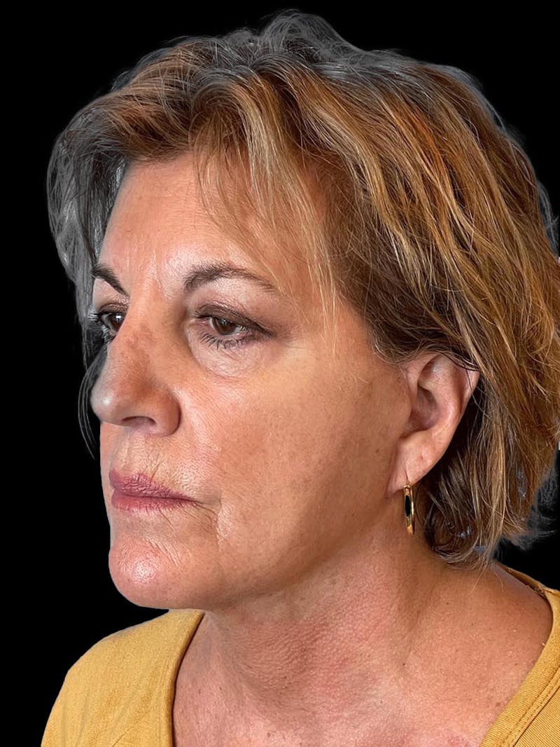 Necklift Before & After Gallery - Patient 552891 - Image 4