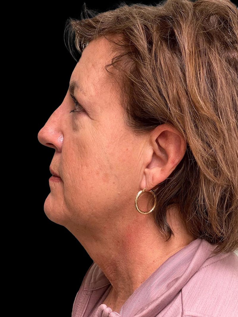 Necklift Before & After Gallery - Patient 552891 - Image 5
