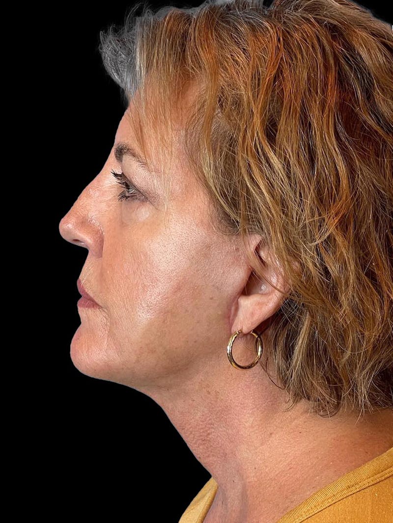 Necklift Before & After Gallery - Patient 552891 - Image 6
