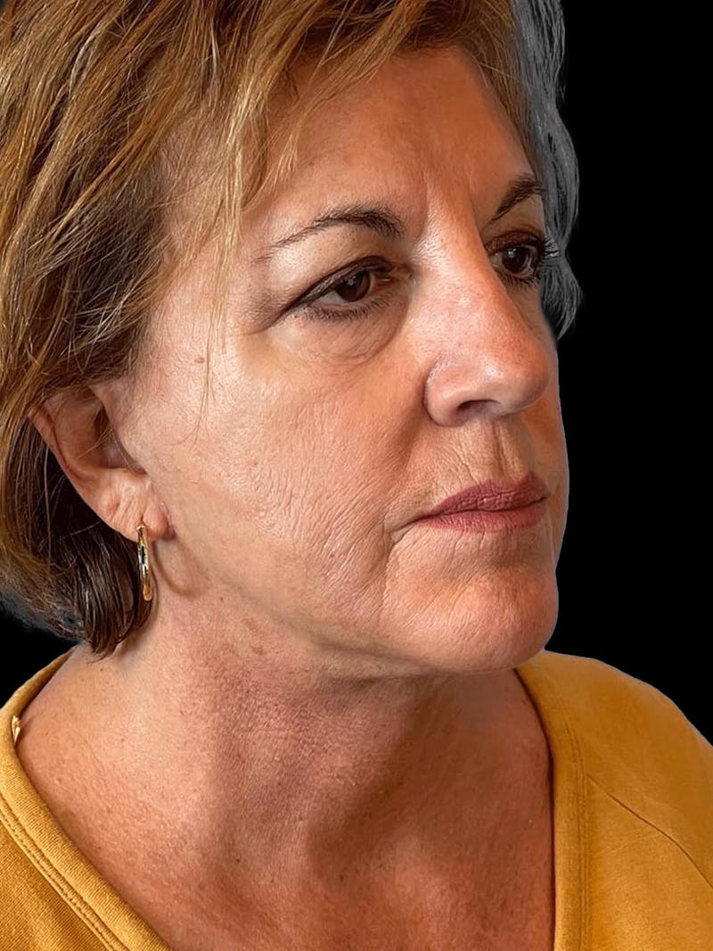 Necklift Before & After Gallery - Patient 552891 - Image 8