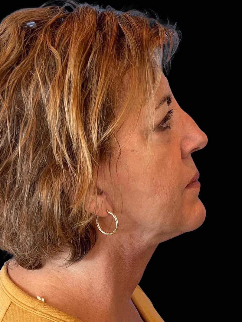 Necklift Before & After Gallery - Patient 552891 - Image 10