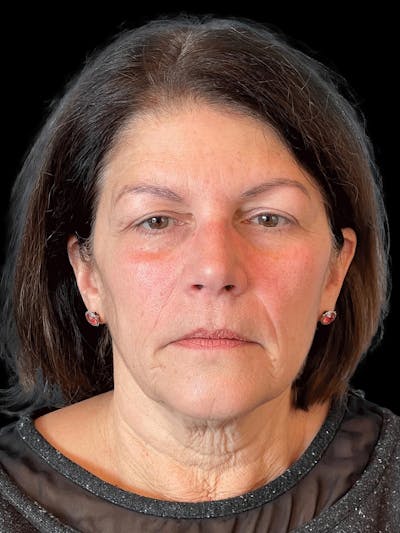 Necklift Before & After Gallery - Patient 338101 - Image 1