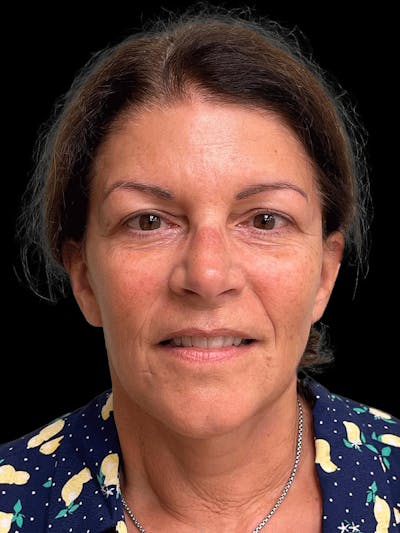 Necklift Before & After Gallery - Patient 338101 - Image 2