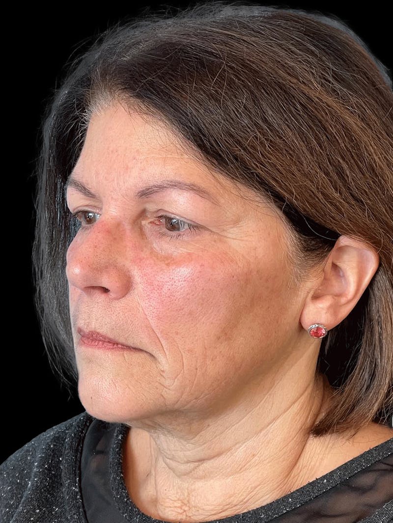 Necklift Before & After Gallery - Patient 338101 - Image 3