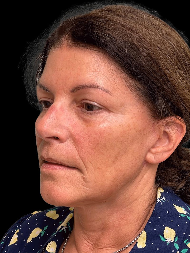 Necklift Before & After Gallery - Patient 338101 - Image 4