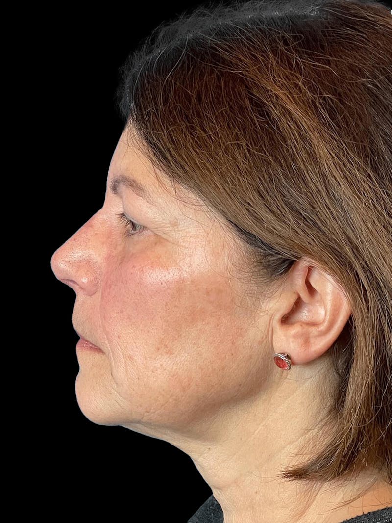 Necklift Before & After Gallery - Patient 338101 - Image 5