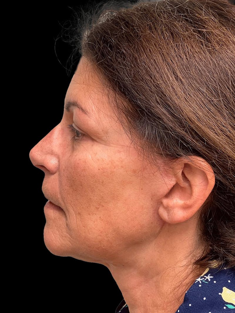 Necklift Before & After Gallery - Patient 338101 - Image 6