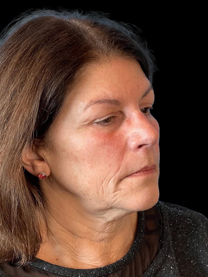 Necklift Before & After Gallery - Patient 338101 - Image 7