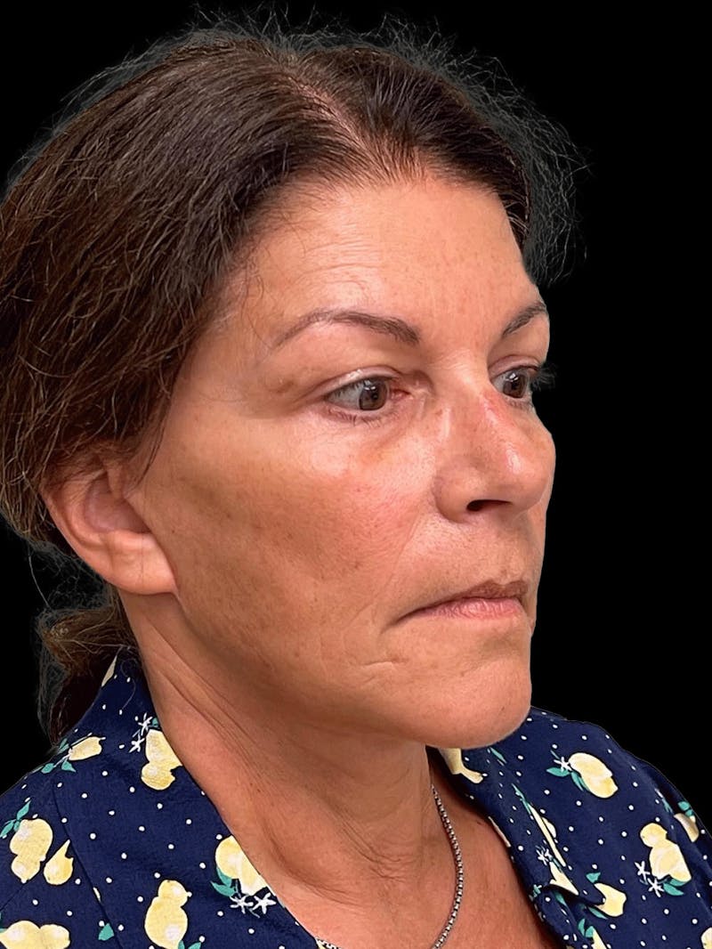 Necklift Before & After Gallery - Patient 338101 - Image 8