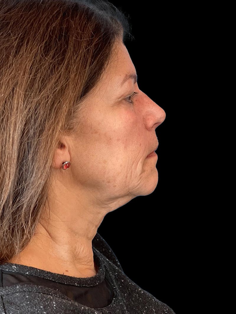 Necklift Before & After Gallery - Patient 338101 - Image 9